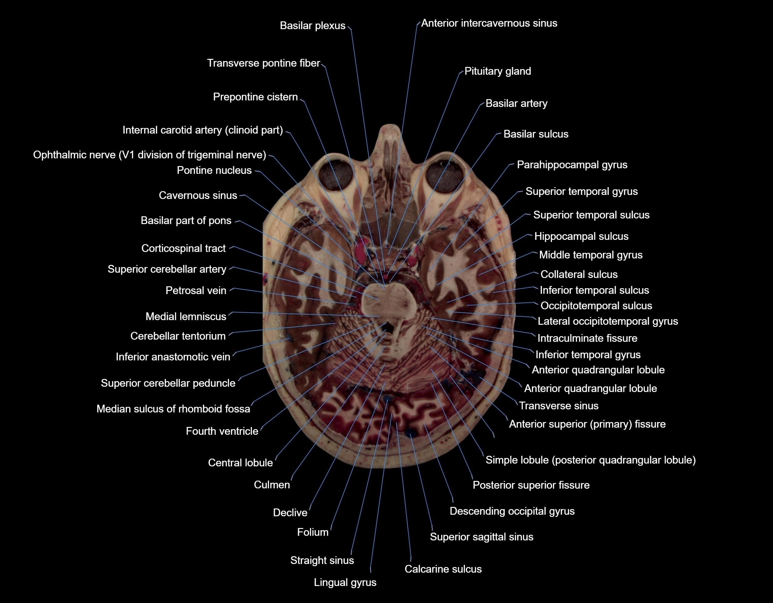 MRI Brain axial cross sectional radiology anatomy 3T image  -img-000027.webp